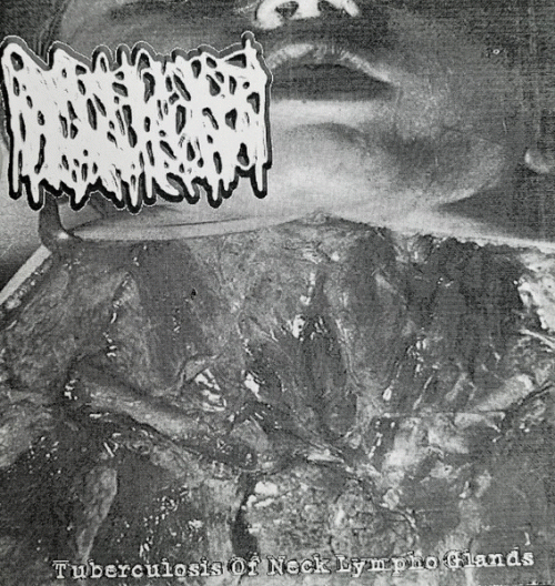 Hydrocephalus : Tubercolosis of Neck Lympho Glands Hydrocephalus : Tubercolosis of Neck Lympho Glands